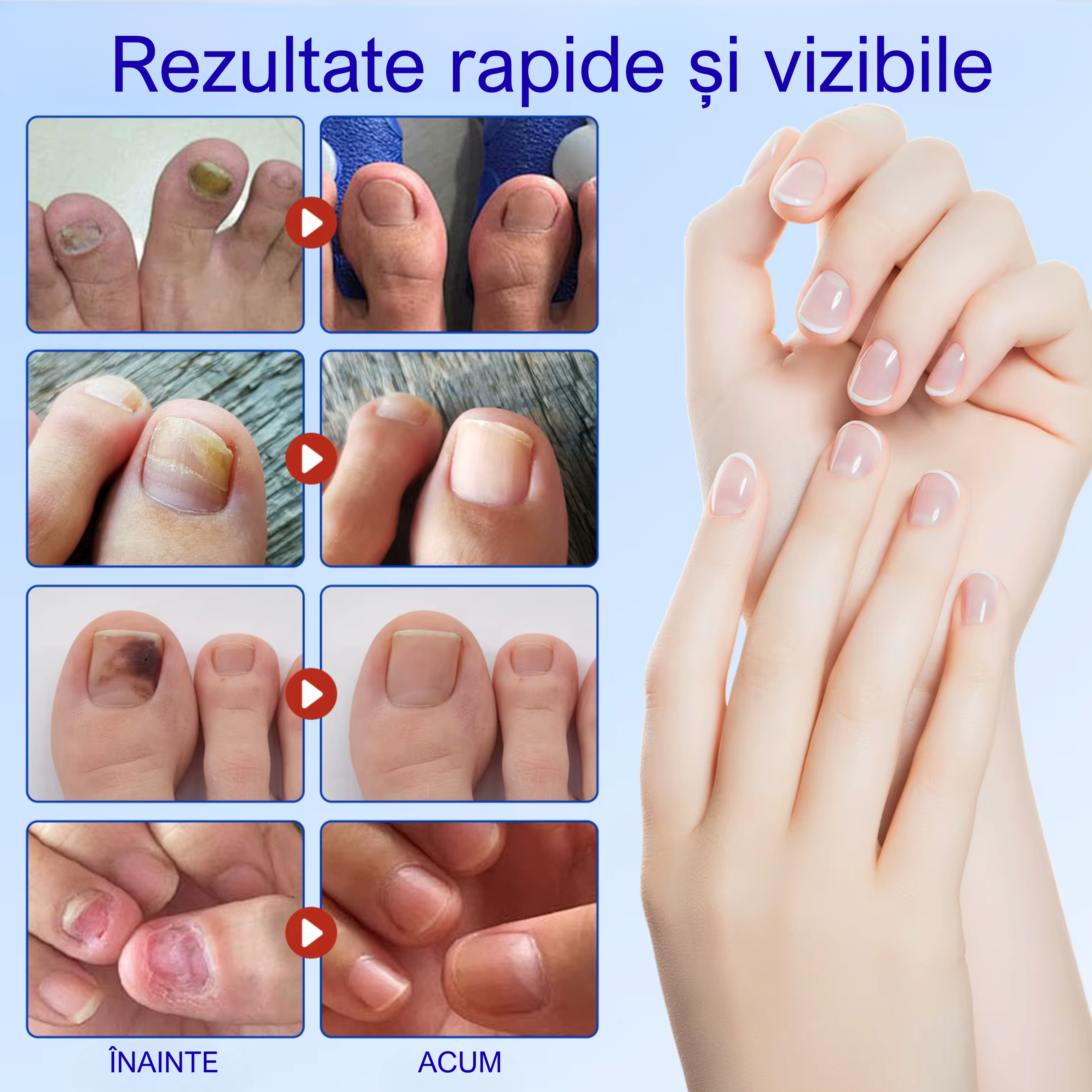 Plasturi antifungici pentru unghii